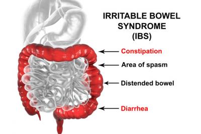 LDN can treat IBS